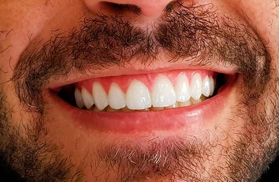 Lente de Contato Dental: Como Funciona e Quando Colocar?