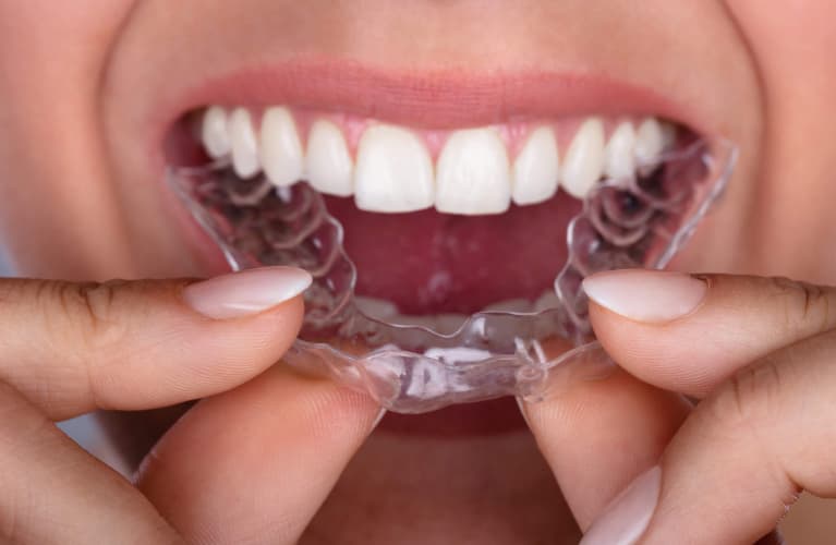 Invisalign