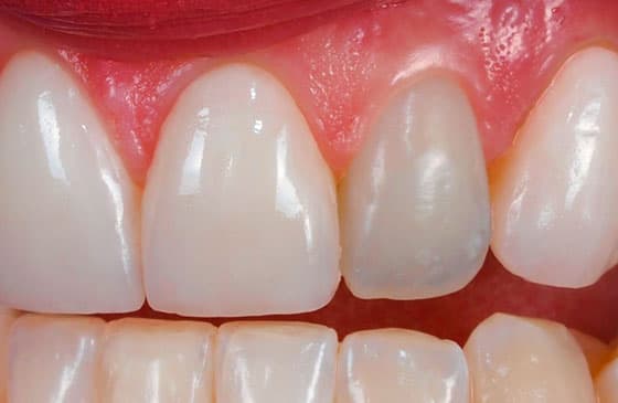 Dente escuro ou escurecido, saiba o que fazer e quais alternativas para o tratamento