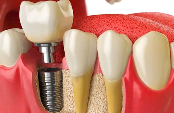 Implantes Dentários, conheça os tipos e saiba qual é o melhor para você