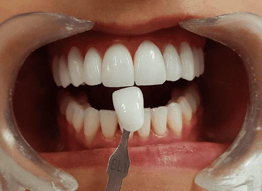 Cor dos Dentes