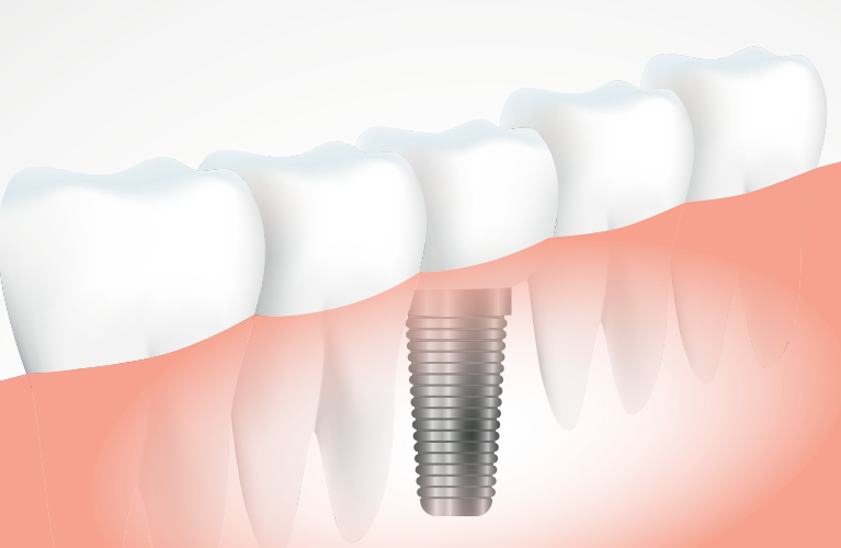 Implante Dentario