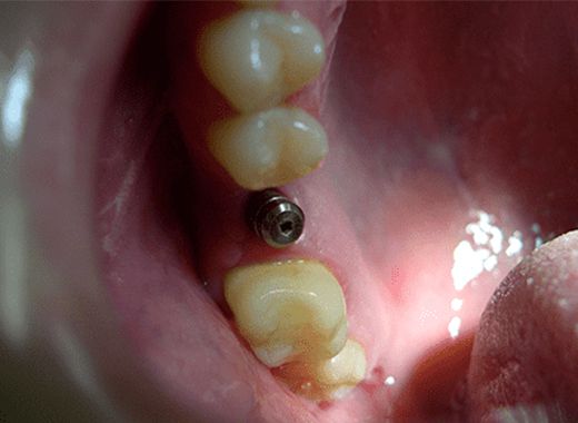 Implante Dental Antes