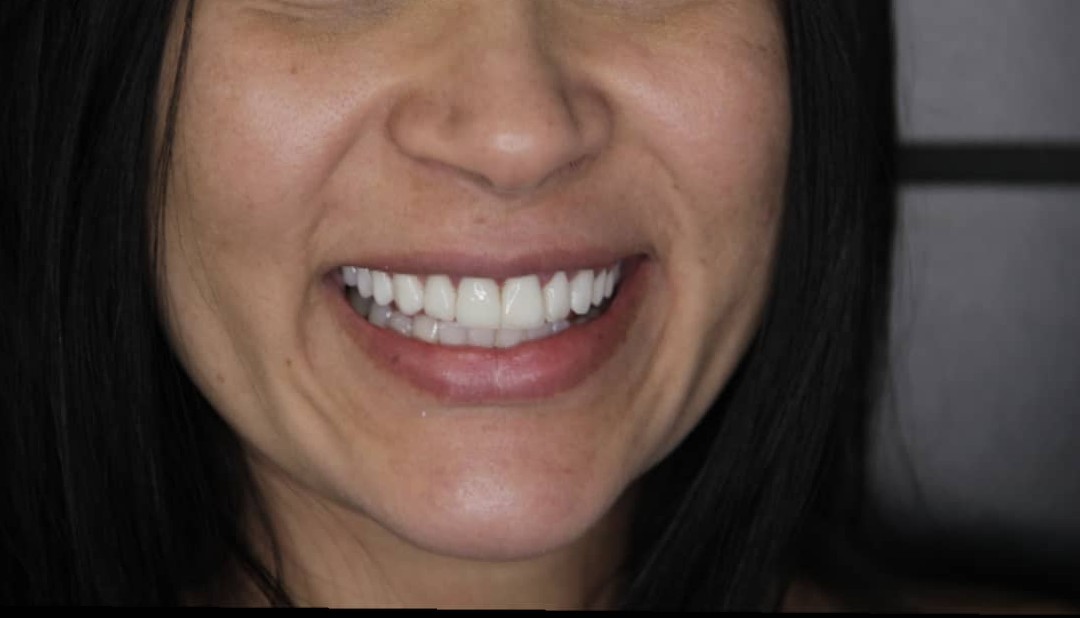 Lentes de Contato Dental em Porcelana na Arcada Superior - Controle de 06 anos.