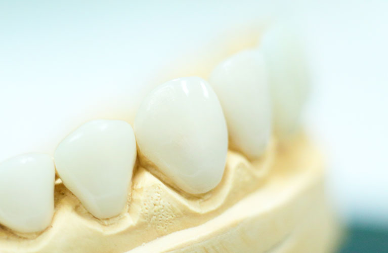 Lente de Contato Dental de Porcelana