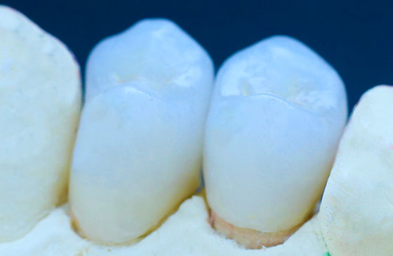 coroa de porcelana para aumentar dentes pequenos