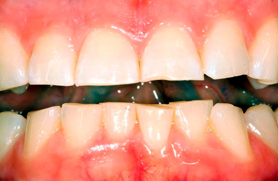 aumentar dentes pequenos e desgastados