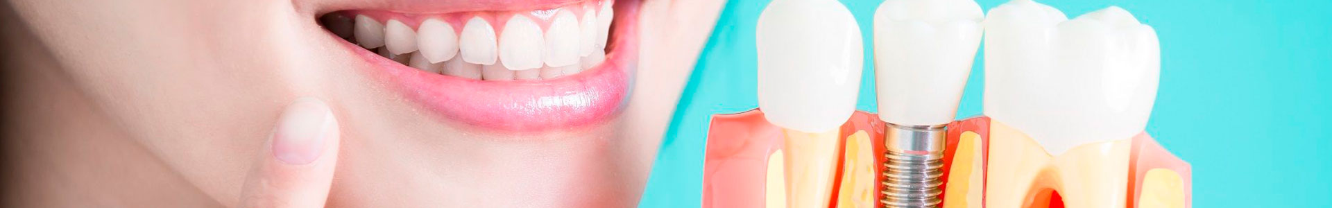 Tipos de Implantes Dentários | Qual é o melhor para você?