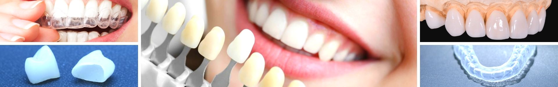 Técnicas de Estética Dental | 5 formas de dar um UP no seu SORRISO!